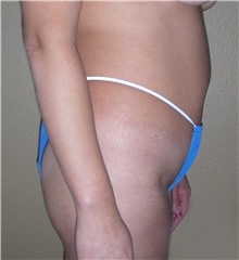 Buttock Lift with Augmentation Before Photo by Stanley Castor, MD; Tampa, FL - Case 39317