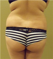 Buttock Lift with Augmentation Before Photo by Stanley Castor, MD; Tampa, FL - Case 39319