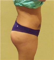 Buttock Lift with Augmentation After Photo by Stanley Castor, MD; Tampa, FL - Case 39319
