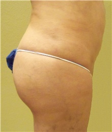 Buttock Lift with Augmentation After Photo by Stanley Castor, MD; Tampa, FL - Case 39320