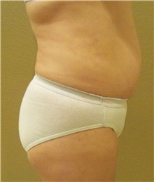 Buttock Lift with Augmentation Before Photo by Stanley Castor, MD; Tampa, FL - Case 39320