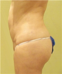 Buttock Lift with Augmentation After Photo by Stanley Castor, MD; Tampa, FL - Case 39320