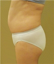 Buttock Lift with Augmentation Before Photo by Stanley Castor, MD; Tampa, FL - Case 39320