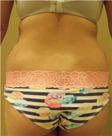 Buttock Lift with Augmentation Before Photo by Stanley Castor, MD; Tampa, FL - Case 39321