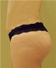 Buttock Lift with Augmentation After Photo by Stanley Castor, MD; Tampa, FL - Case 39321