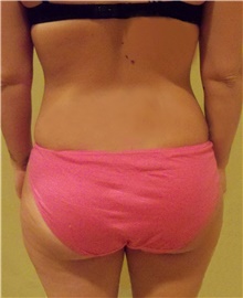 Buttock Lift with Augmentation Before Photo by Stanley Castor, MD; Tampa, FL - Case 39322
