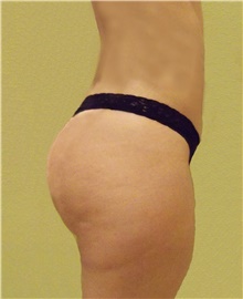Buttock Lift with Augmentation After Photo by Stanley Castor, MD; Tampa, FL - Case 39322