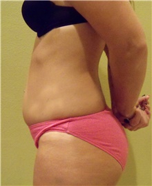 Buttock Lift with Augmentation Before Photo by Stanley Castor, MD; Tampa, FL - Case 39322