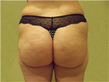 Buttock Lift with Augmentation Before Photo by Stanley Castor, MD; Tampa, FL - Case 39323