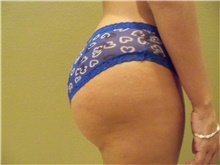 Buttock Lift with Augmentation After Photo by Stanley Castor, MD; Tampa, FL - Case 39323