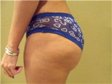 Buttock Lift with Augmentation After Photo by Stanley Castor, MD; Tampa, FL - Case 39323
