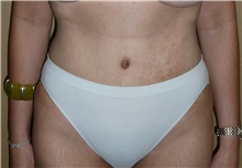 Tummy Tuck After Photo by Stanley Castor, MD; Tampa, FL - Case 39324