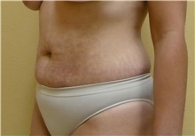 Tummy Tuck Before Photo by Stanley Castor, MD; Tampa, FL - Case 39324