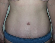 Tummy Tuck After Photo by Stanley Castor, MD; Tampa, FL - Case 39325