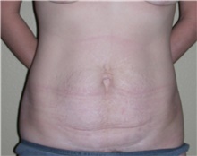 Tummy Tuck Before Photo by Stanley Castor, MD; Tampa, FL - Case 39325