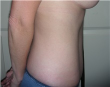 Tummy Tuck After Photo by Stanley Castor, MD; Tampa, FL - Case 39325