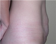 Tummy Tuck Before Photo by Stanley Castor, MD; Tampa, FL - Case 39325