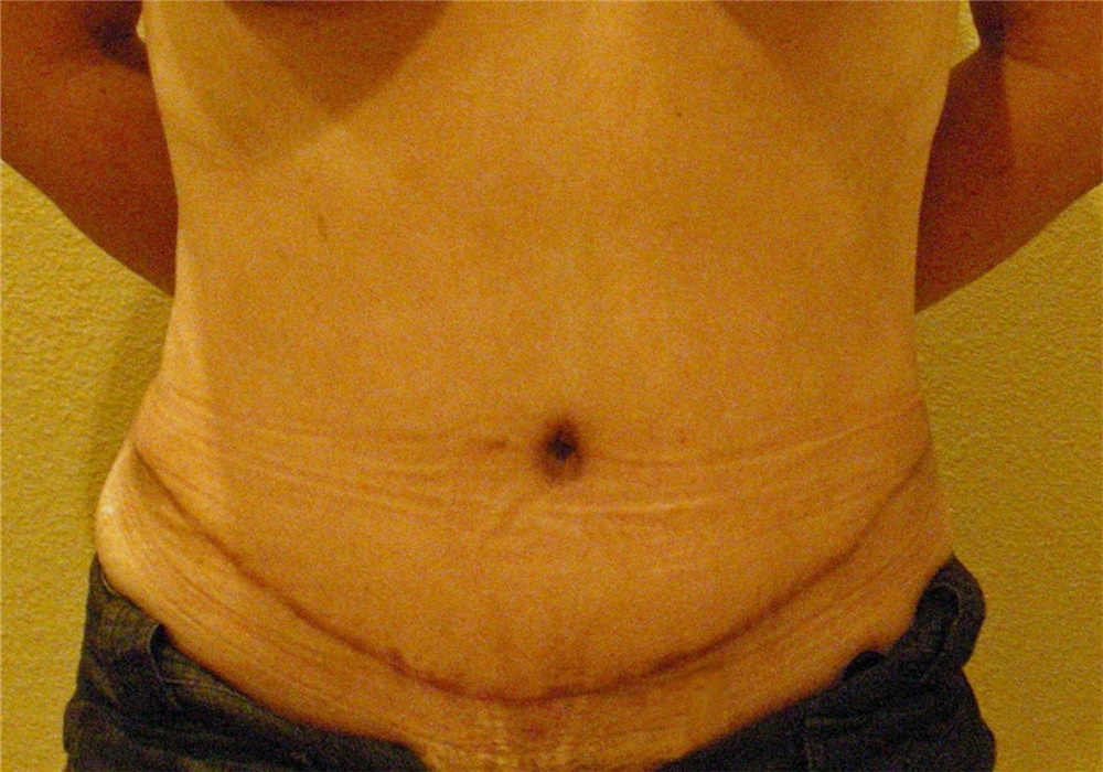 Tummy Tuck Revision Surgery Tampa FL