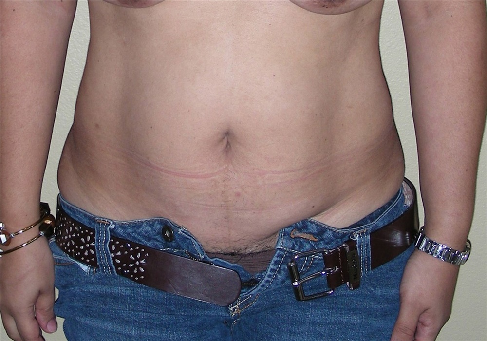 Tummy Tuck Before and After Photos by Stanley Castor, MD; Tampa