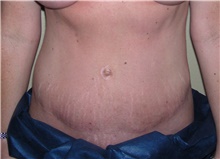 Tummy Tuck After Photo by Stanley Castor, MD; Tampa, FL - Case 39329