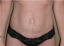 Tummy Tuck Before Photo by Stanley Castor, MD; Tampa, FL - Case 39329
