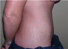Tummy Tuck After Photo by Stanley Castor, MD; Tampa, FL - Case 39329