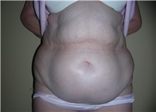 Tummy Tuck Before Photo by Stanley Castor, MD; Tampa, FL - Case 39331