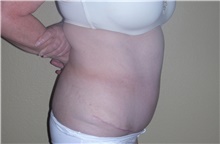 Tummy Tuck After Photo by Stanley Castor, MD; Tampa, FL - Case 39331