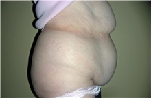 Tummy Tuck Before Photo by Stanley Castor, MD; Tampa, FL - Case 39331