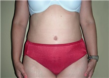 Tummy Tuck After Photo by Stanley Castor, MD; Tampa, FL - Case 39333