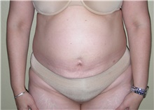 Tummy Tuck Before Photo by Stanley Castor, MD; Tampa, FL - Case 39333
