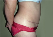 Tummy Tuck After Photo by Stanley Castor, MD; Tampa, FL - Case 39333