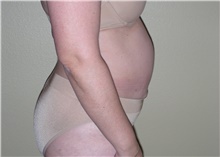 Tummy Tuck Before Photo by Stanley Castor, MD; Tampa, FL - Case 39333