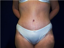 Tummy Tuck After Photo by Stanley Castor, MD; Tampa, FL - Case 39334