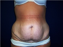 Tummy Tuck Before Photo by Stanley Castor, MD; Tampa, FL - Case 39334