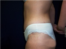 Tummy Tuck After Photo by Stanley Castor, MD; Tampa, FL - Case 39334
