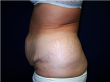 Tummy Tuck Before Photo by Stanley Castor, MD; Tampa, FL - Case 39334