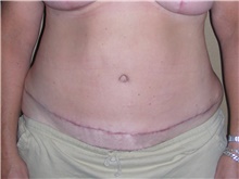 Tummy Tuck After Photo by Stanley Castor, MD; Tampa, FL - Case 39335