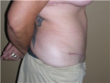 Tummy Tuck After Photo by Stanley Castor, MD; Tampa, FL - Case 39335