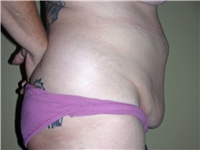 Tummy Tuck Before Photo by Stanley Castor, MD; Tampa, FL - Case 39335