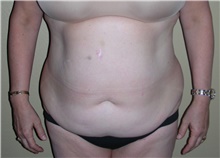 Tummy Tuck Before Photo by Stanley Castor, MD; Tampa, FL - Case 39336