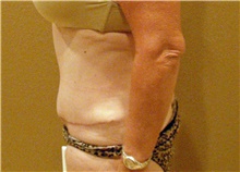 Tummy Tuck After Photo by Stanley Castor, MD; Tampa, FL - Case 39336