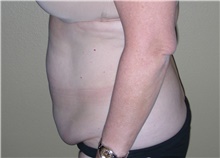 Tummy Tuck Before Photo by Stanley Castor, MD; Tampa, FL - Case 39336