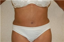 Tummy Tuck After Photo by Stanley Castor, MD; Tampa, FL - Case 39337