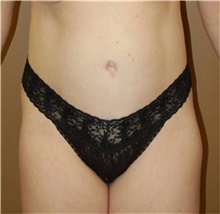 Tummy Tuck After Photo by Stanley Castor, MD; Tampa, FL - Case 39338