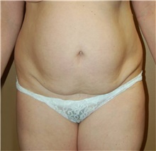 Tummy Tuck Before Photo by Stanley Castor, MD; Tampa, FL - Case 39338