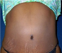 Tummy Tuck After Photo by Stanley Castor, MD; Tampa, FL - Case 39339