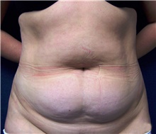 Tummy Tuck After Photo by Stanley Castor, MD; Tampa, FL - Case 39340