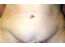 Tummy Tuck After Photo by Stanley Castor, MD; Tampa, FL - Case 39341