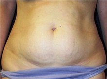 Tummy Tuck Before Photo by Stanley Castor, MD; Tampa, FL - Case 39341